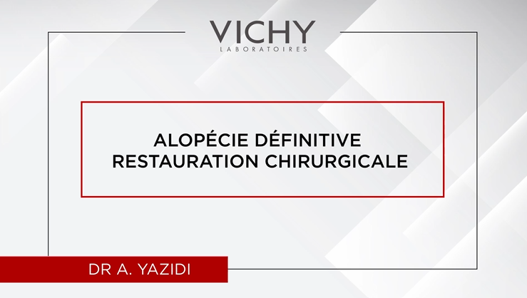 Alopécie définitive restauration chirurgicale par DR A. YAZIDI