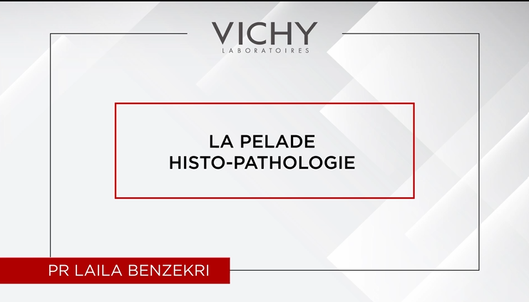 La pelade Histo-Pathologie par Pr L. BENZEKRI