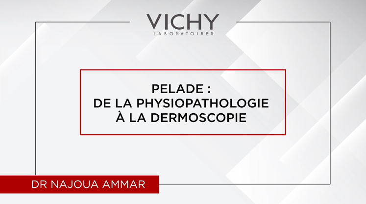 Pelade : De la physiopathologie à la dermoscopie par Dr N. AMMAR